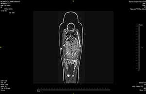 CT scan of the mummy Amen-Nestawy-Nakht, who died at age 36. Image courtesy of Washington University School of Medicine.